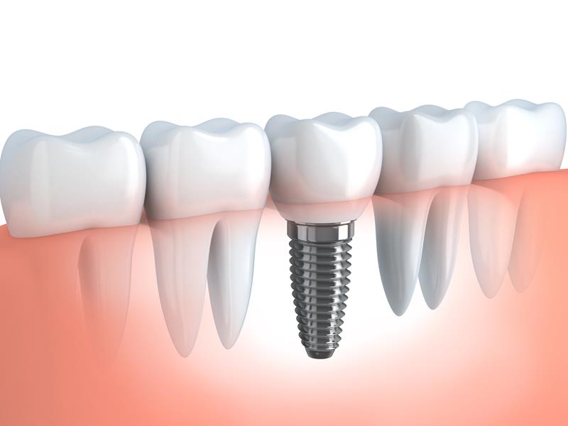 Dental Implants St. George, UT